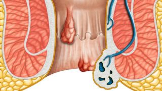 10 Best Essential Oils for Hemorrhoids