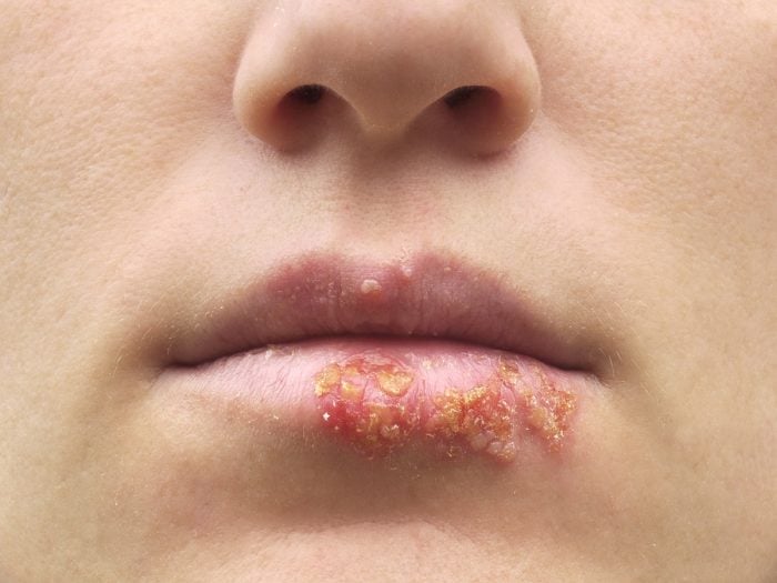 Herpes Types Symptoms Causes And Treatments Organic Facts