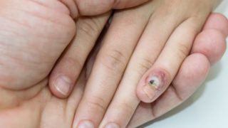 A flat wart found on a boy's little finger suffering from human papillomavirus