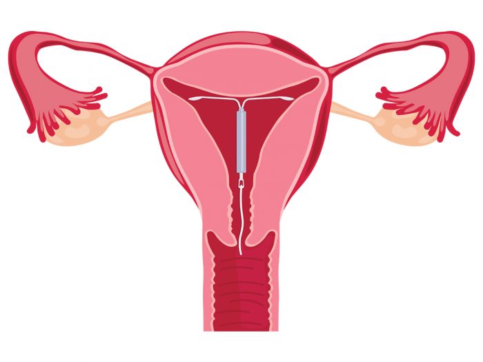 iud types