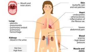 An illustration of a human body suffering from lupus