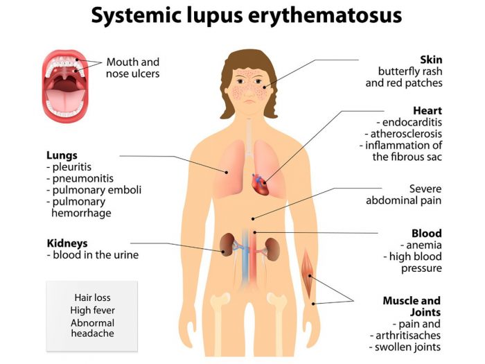An illustration of a human body suffering from lupus
