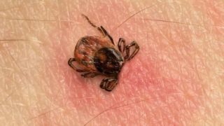Human skin with a tick bite and tick on it