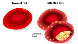 A picture showing normal and infected red blood cells during malaria