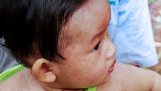 Measles