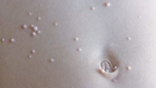 Close up of molluscum contagiosum on the abdomen