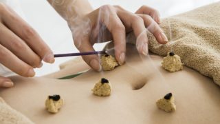 Moxa cones being burned on the stomach