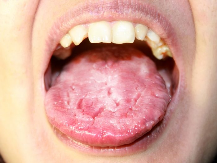 Symtoms Of Oral Thrush 102