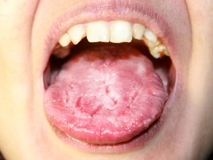 Cause Of Oral Thrush 22