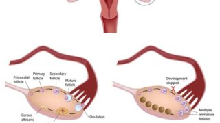 A depiction of Polycystic ovary syndrome (PCOS)