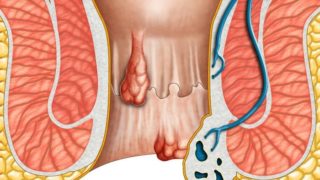 28 Remedies & Treatments for Hemorrhoids or Piles
