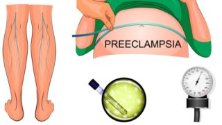 preeclampsia