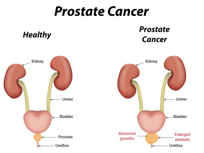 Image result for prostate cancer