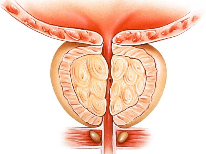 Graphic depicting prostate cancer.
