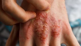 9 Best Essential Oils for Psoriasis
