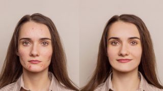 16 Effective Ways to Remove Acne Scars