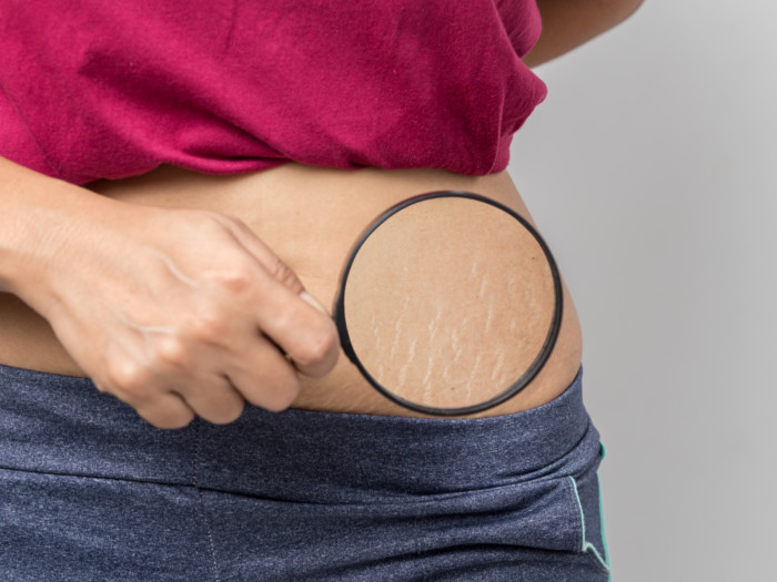 A girl holding a magnifying glass and showing the stretch marks around her waist