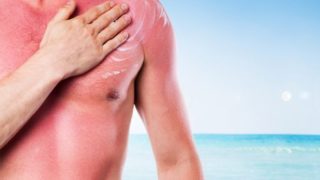 5 Best Essential Oils for Sunburn