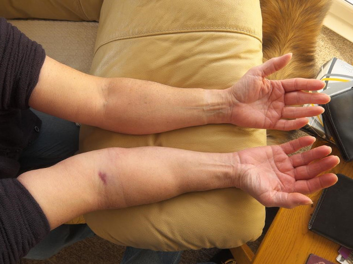 A person resting swollen hands on a sofa cushion