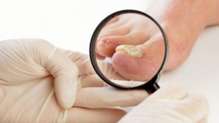 9 Amazing Essential Oils for Toenail Fungus