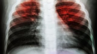 A 2D illustration of a human lung suffering from tuberculosis