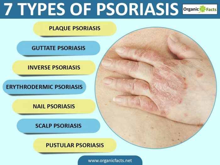 Image result for psoriasis images